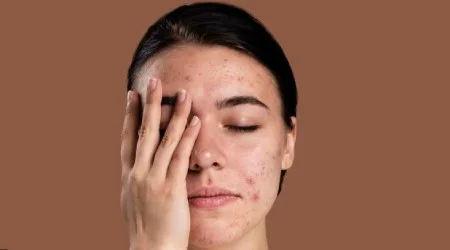 استفاده از کرمهای ضدآفتاب مناسب برای پوست های حساس