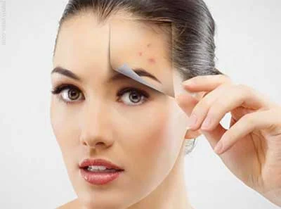 از بین بردن جوش های صورت,مقابله با جوش صورت,درمان جوش های صورت