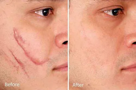 سابسیژن , سابسیژن پوست , سابسیژن چیست