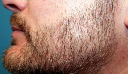 ضخیم شدن ریش و سبیل, پرپشت کردن ریش, چگونه جاهای خالی ریش را پر کنیم