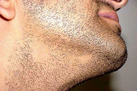 ضخیم شدن ریش و سبیل, پرپشت کردن ریش, چگونه جاهای خالی ریش را پر کنیم