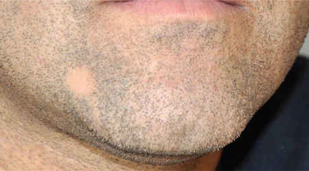ضخیم شدن ریش و سبیل, پرپشت کردن ریش, چگونه جاهای خالی ریش را پر کنیم