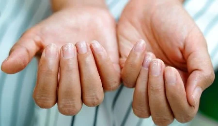 ناخن افتاده چگونه رشد می کند