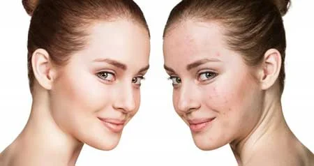 روش میکرونیدلینگ, عوارض میکرونیدلینگ, جوانسازی پوست بامیکرونیدلینگ