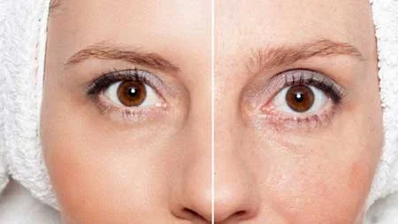 روش میکرونیدلینگ, عوارض میکرونیدلینگ, جوانسازی پوست بامیکرونیدلینگ