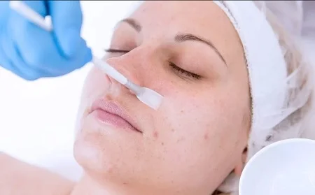 مزایای اسید تراپی برای پوست, اسید درمانی پوست, اسیدتراپی پوست