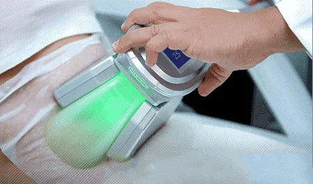 لاغری سریع,دستگاه های لاغری,کرایولیپولیز