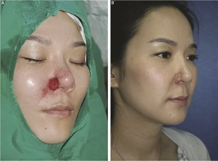 نکروز بینی در اثر تزریق ژل, روش درمان نکروز بینی, نکروز پوست بینی