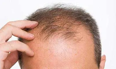 چرا موهای مردها می‌ریزد؟