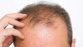 چرا موهای مردها می‌ریزد؟
