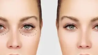 چگونه برای انجام عمل بلفاروپلاستی آماده شویم؟