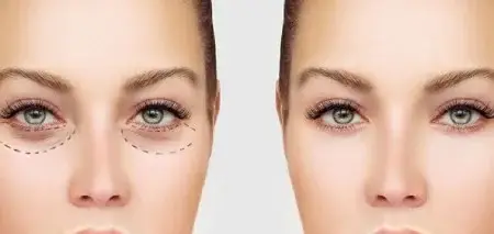 چگونه برای انجام عمل بلفاروپلاستی آماده شویم؟