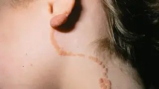 علل، علایم و درمان خال اپیدرمال