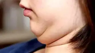 چگونه چربی گردن را از بین ببریم؟