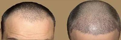 کاشت مو به روش SUT + چند نکته مهم قبل از کاشت مو