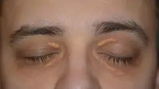 علل، علائم و راههای درمان زانتلاسما (توده چربی گوشه چشم)