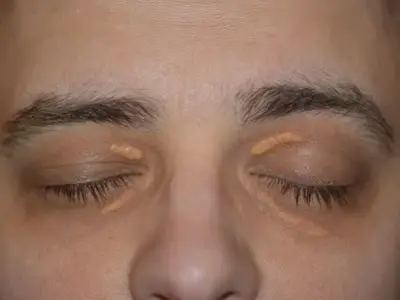 علل، علائم و راههای درمان زانتلاسما (توده چربی گوشه چشم)