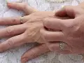 عارضه پوست موسوم به خارش زمستانی
