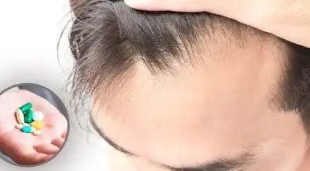 اثرگذاری داروها بر روی مو: بررسی ارتباط داروها و سلامت مو