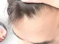 اثرگذاری داروها بر روی مو: بررسی ارتباط داروها و سلامت مو