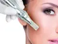 میکرونیدلینگ طبیعی ترین و موثرترین روش جوانسازی و ترمیم پوست