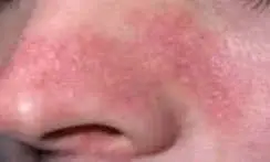پیشگیری از اگزما با آبرسانی پوست در فصل سرما