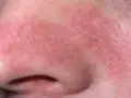 پیشگیری از اگزما با آبرسانی پوست در فصل سرما