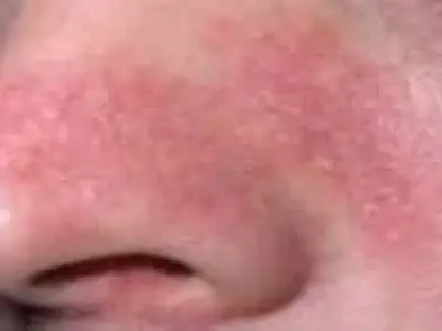 پیشگیری از اگزما با آبرسانی پوست در فصل سرما