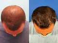مزایا ، مراحل و مراقبت بعد از کاشت موی ترکیبی