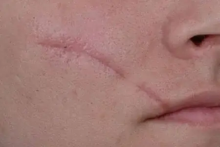 پاک کردن جای زخم از روی پوست