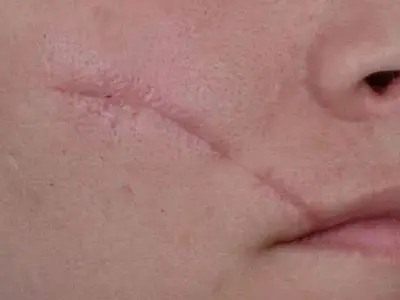 پاک کردن جای زخم از روی پوست