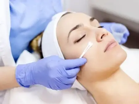 اسید تراپی پوست راهی برای جوانسازی و درمان لک و جوش
