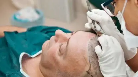 نکات مهم قبل و بعد از کاشت مو