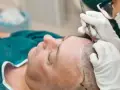 نکات مهم قبل و بعد از کاشت مو
