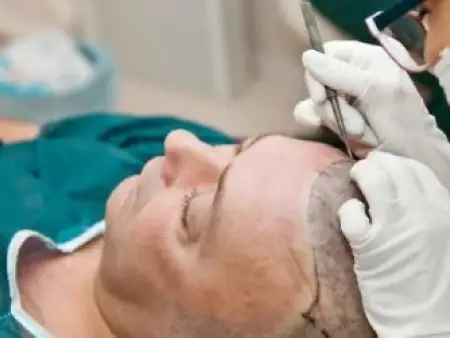 نکات مهم قبل و بعد از کاشت مو