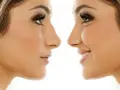 تغییر شکل بینی بدون جراحی با لیزر و بدون بیهوشی