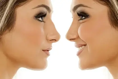 تغییر شکل بینی بدون جراحی با لیزر و بدون بیهوشی