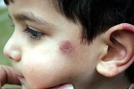 علت ،علائم و درمان سالک