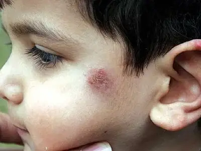 علت ،علائم و درمان سالک
