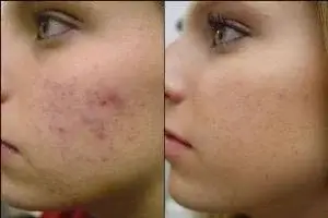 ازبین بردن تیرگی جای جوش های صورت