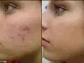 ازبین بردن تیرگی جای جوش های صورت