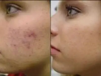 ازبین بردن تیرگی جای جوش های صورت
