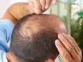 ریزش موی ارثی: چگونه ژنتیک بر ریزش مو تأثیر می گذارد
