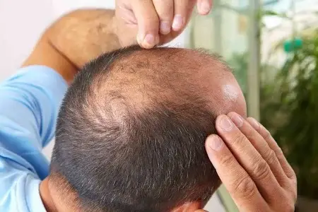 ریزش موی ارثی: چگونه ژنتیک بر ریزش مو تأثیر می گذارد