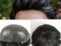 پروتز مو مردانه چیست و انواع آن کدامند؟
