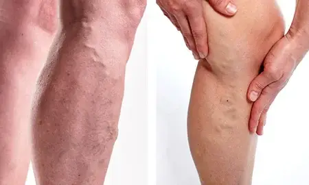 پنج ترفند ساده برای پوشاندن رگهای واریسی