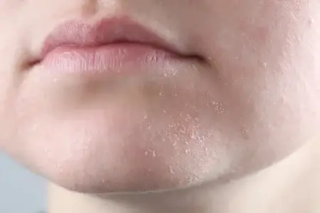 چگونه از خشکی و ترک پوست در نواحی مختلف بدن جلوگیری کنیم؟