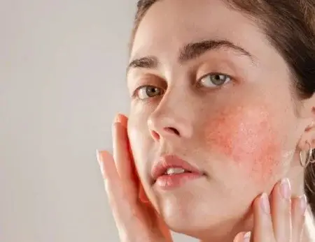 چطور قرمزی پوست صورت را برطرف کنیم؟
