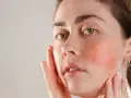 چطور قرمزی پوست صورت را برطرف کنیم؟