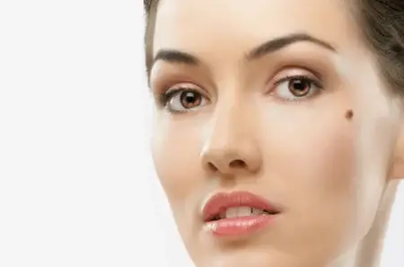 علائم هشدار دهنده در مورد خال ها